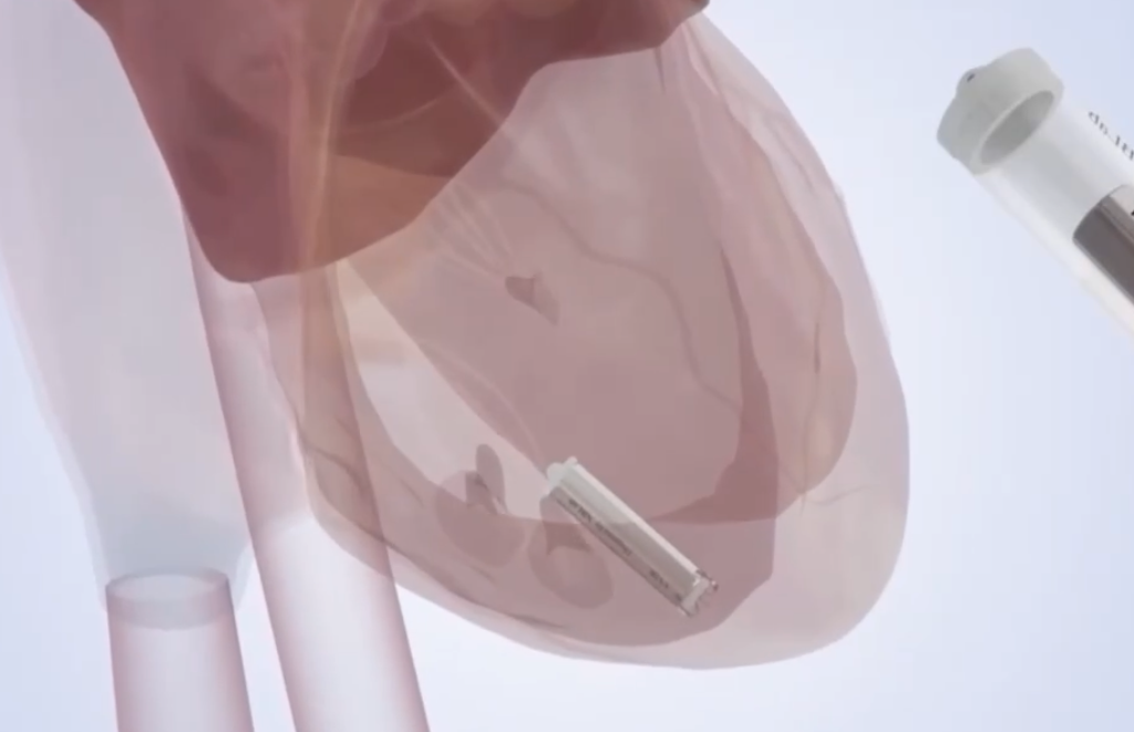 Heartbeat-Powered Pacemaker Promises Longer-Lasting Cardiac Implants